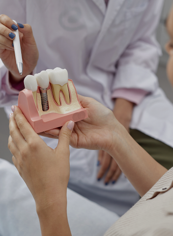 Implante Dentário múltiplo ou unitário